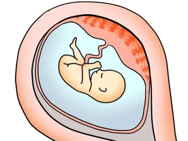 胎盘低是胎盘位置接近宫颈口