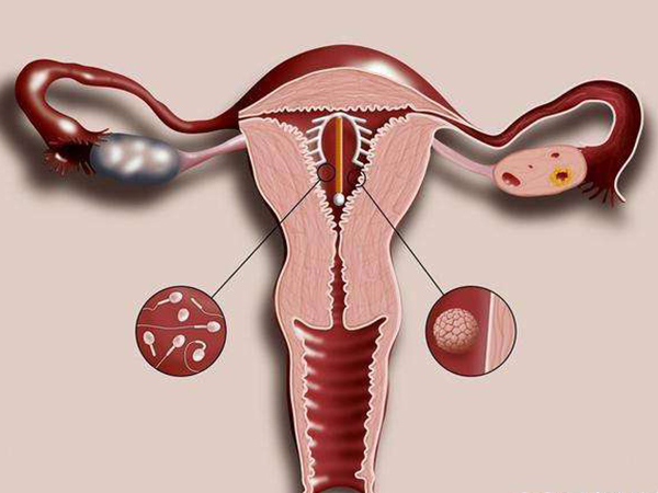 宫外孕早期在输卵管膨大导致女性腹痛