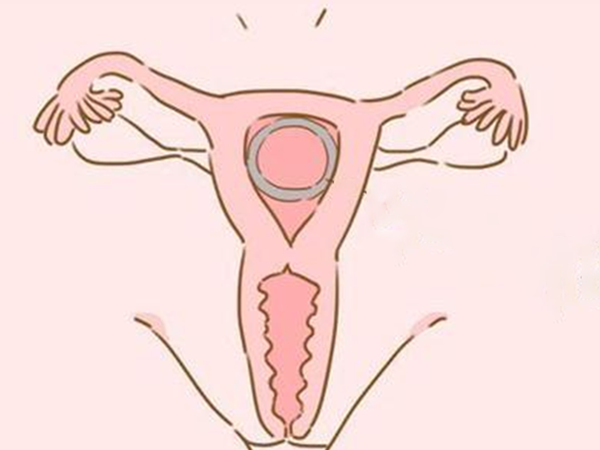 避孕环避孕原理是阻碍胚胎着床