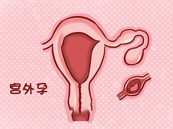 宫外孕会导致不规则出血