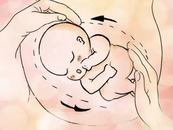 外转胎位术可以纠正胎位