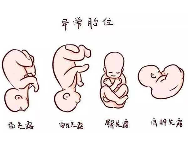胎儿胎位是指胎儿在子宫内的动作位置,一般正确的胎位是抬头朝下,头部