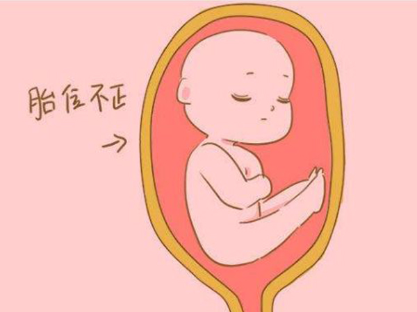 孕妇胎位不正的原因与骨盆狭窄有关
