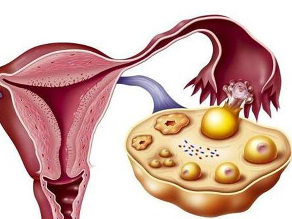 多囊卵巢需要促排卵