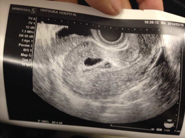 怀孕35天双胞胎b超会出现两个孕囊