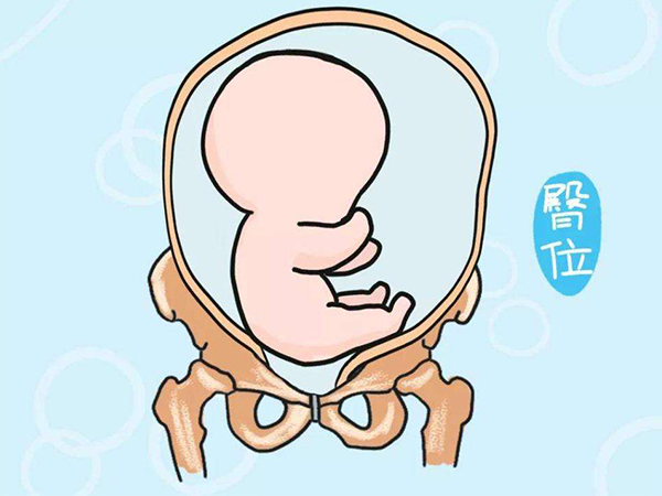 臀位胎儿发育不健康与胎位无关