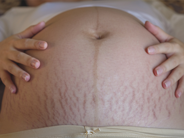 看妊娠纹位置可辨别胎儿性别