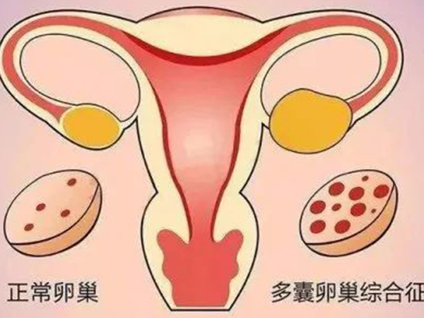 多囊患者备孕期间不能吃黑豆
