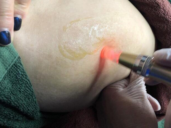 妊娠纹有多种有效治疗方法