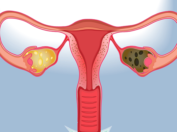 子宫内膜正常的女性移植成功率较高
