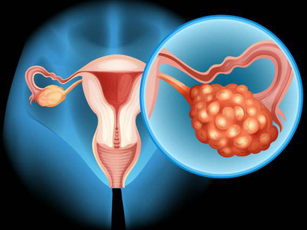 多囊卵巢会导致月经紊乱