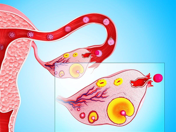导致空卵泡的原因有很多