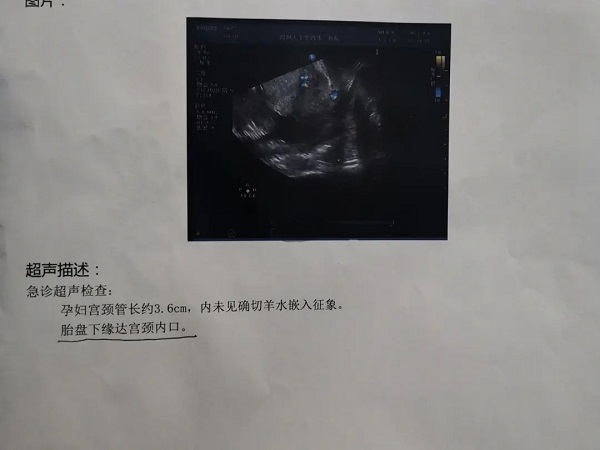 胎盘低置的报告单图片