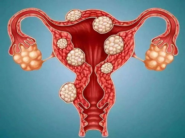 子宫肌瘤是最常见的妇科疾病