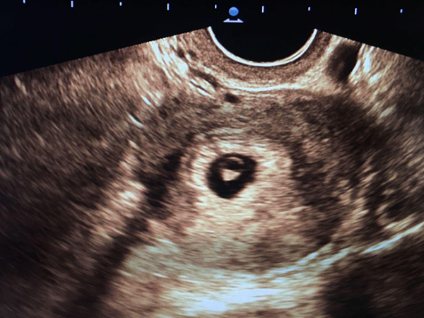 孕囊形状可以看出胎儿的性别