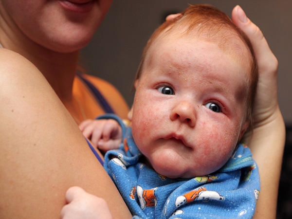 婴儿湿疹和痱子都是非常常见的一个皮肤问题