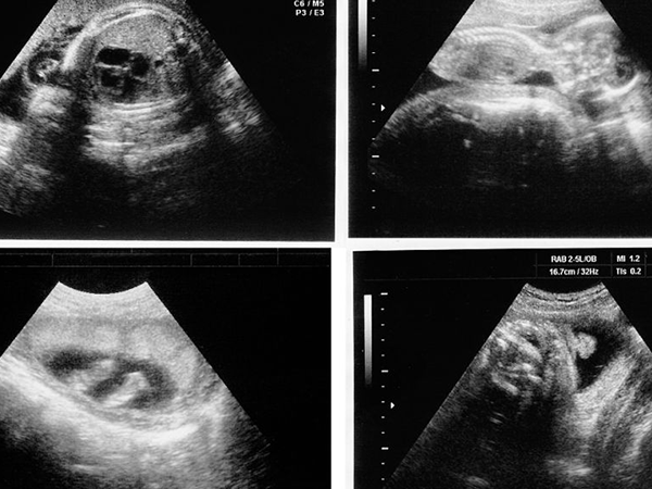 通过孕囊形状可看出胎儿性别