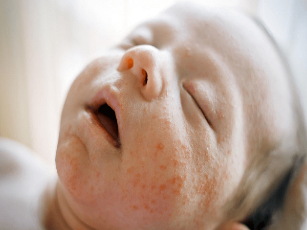 湿疹是最常见的皮肤疾病