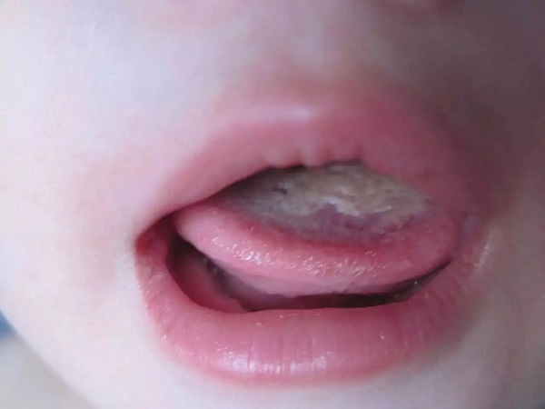 鹅口疮其实就是一种真菌感染,我们每个人的口腔中都有这种白色念珠菌