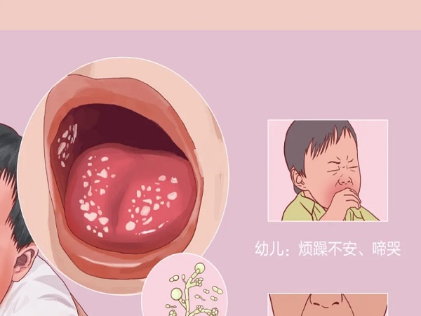 婴儿鹅口疮早期症状图片