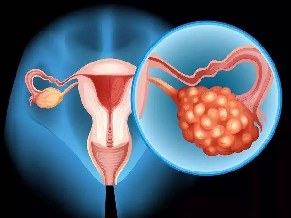 多囊卵巢综合征是常见的妇科疾病