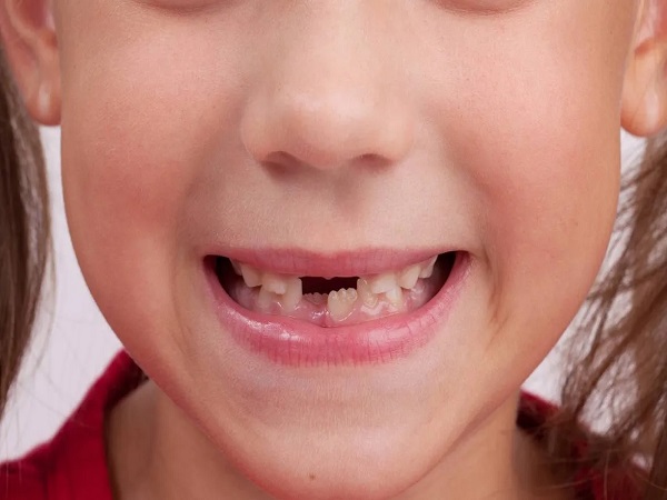 每个孩子都会经历换牙期