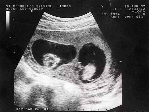 龙凤胎孕囊B超图片