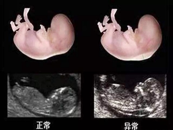 13周胎儿图片真实图片