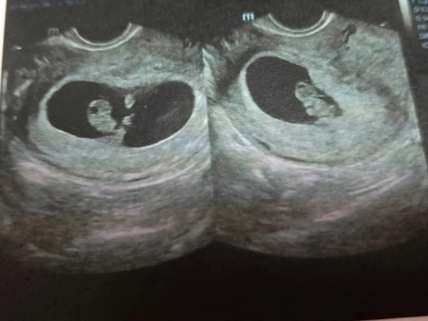 已生男孩孕囊图片分享:根据数据和形状看男女真的很准