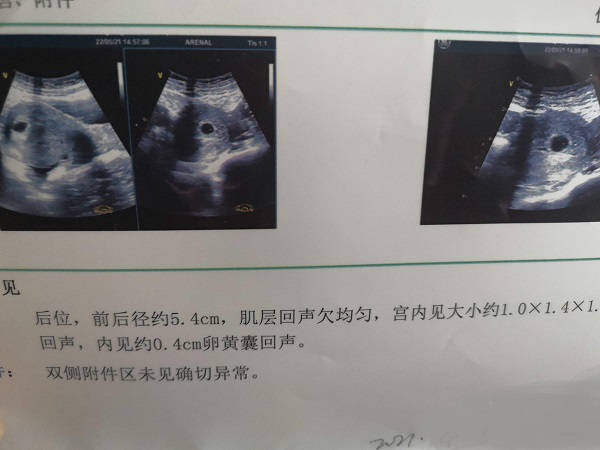 B超孕囊图片