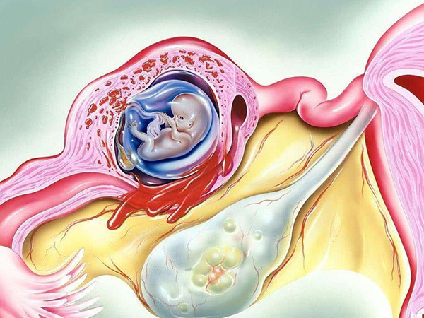 宫外孕在孕早期会发生阴道出血