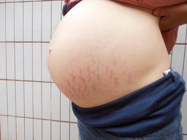 怀女孩的妊娠纹图片