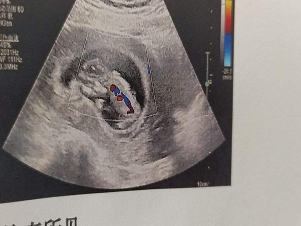 40天的男孩孕囊图片图片