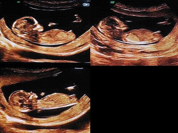 彩超图中胎儿的尾部高低看男女