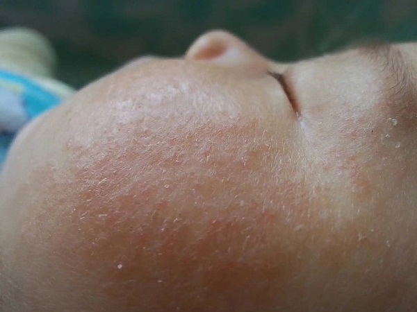 长时间的汗液刺激会导致宝宝长湿疹