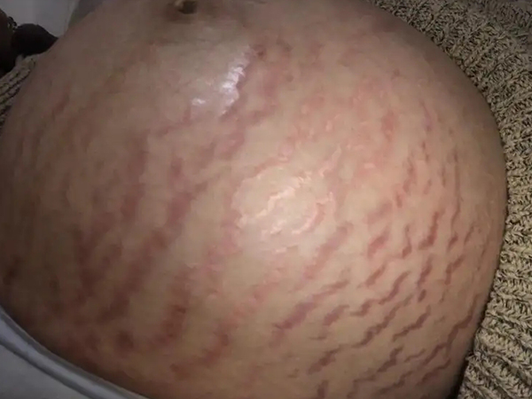 妊娠纹图片初期红点图片