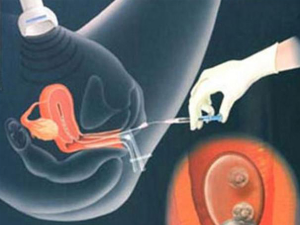 取卵后卵巢过度刺激会导致腹水