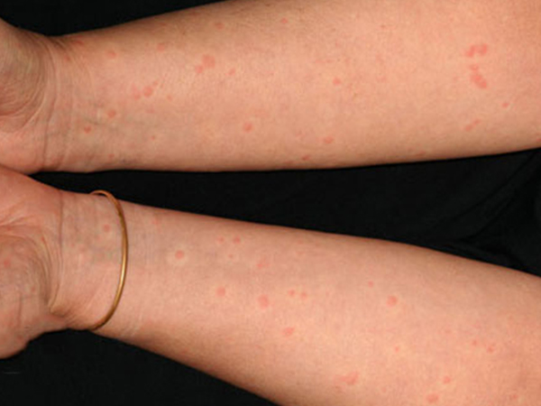 胆碱能性荨麻疹