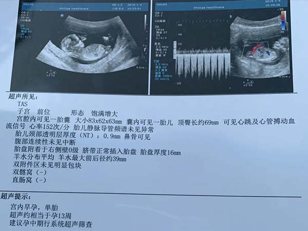 孕12周胎儿nt值小于1mm图片
