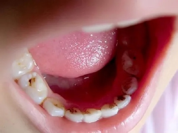 不同情况的蛀牙洞治疗的方法是不同的