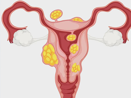 子宫肌瘤对试管婴儿成功率有一定影响