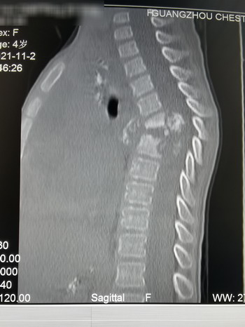 四岁女孩患脊椎结核面临截瘫，90后妈妈“取骨救女”