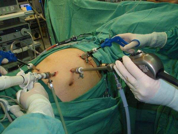 宫腹腔镜手术属于微创手术