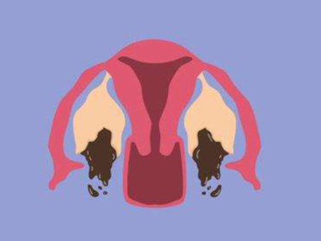 治疗巧囊一般不需要切除卵巢