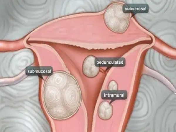 子宫肌瘤是一种常见的妇科疾病