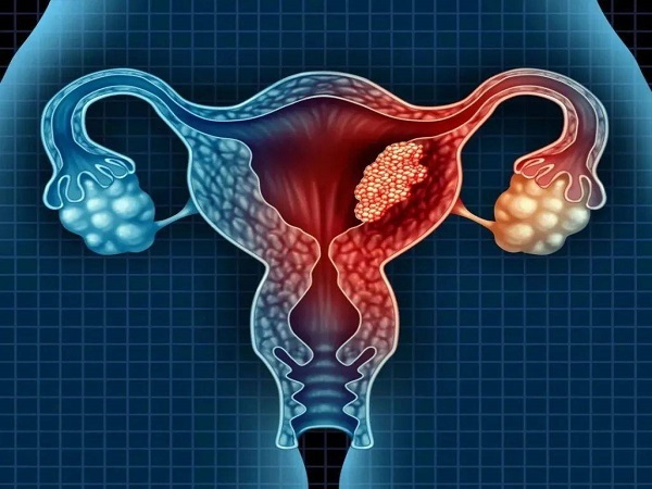 子宫腺肌症是常见的妇科疾病