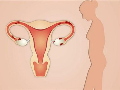 始基子宫是一种严重的先天性生殖器畸形