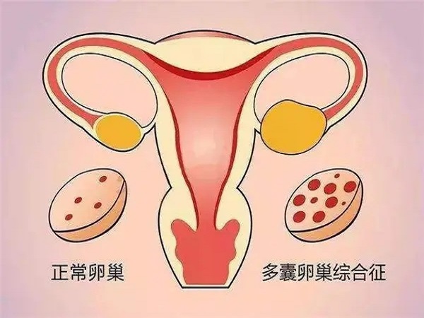 多囊卵巢是一种常见的妇科疾病