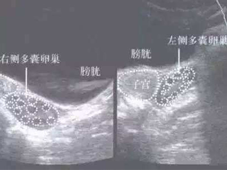 多囊卵巢不排卵会影响怀孕