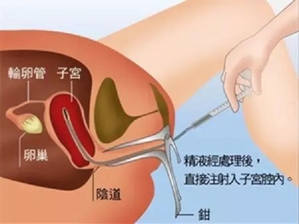 供精人工授精的流程并不复杂